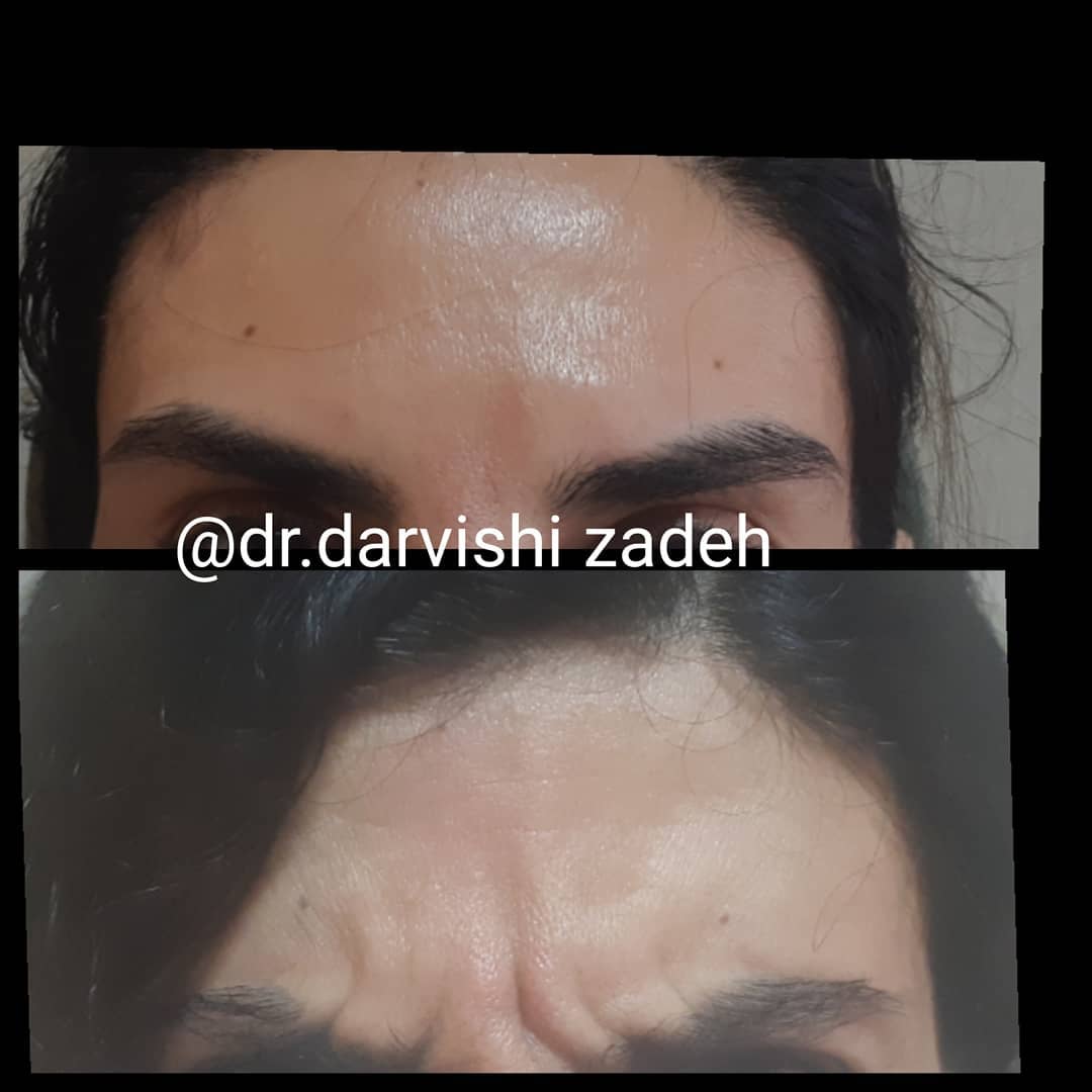 دکتر نادیا درویشی زاده متخصص میکرودرم| بهترین کلینیک پزشک میکرودرم در تهران