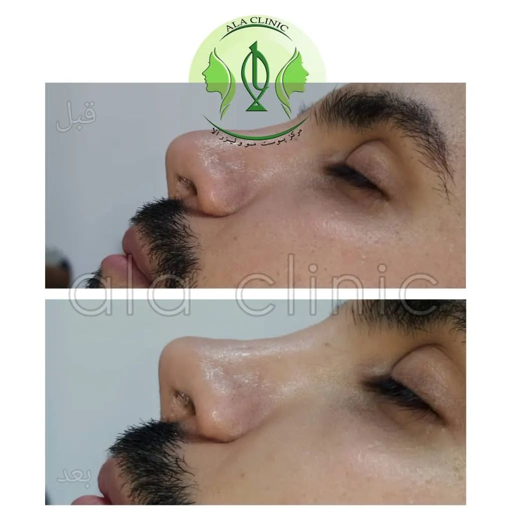 کلینیک تخصصی پوست، مو و لیزر آلا در کرج | بهترین کلینیک کربوکسی تراپی در کرج