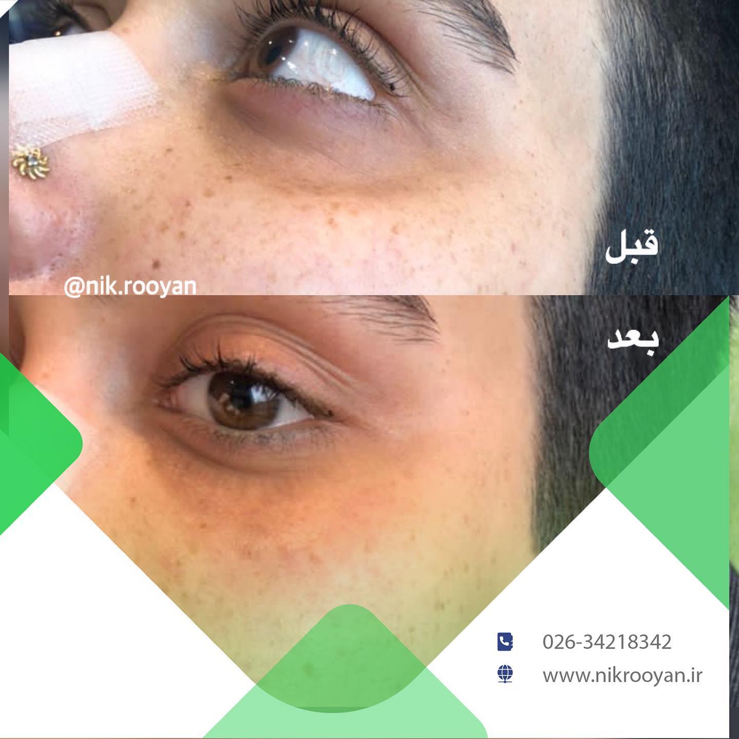 کلینیک تخصصی نیک رویال در کرج | بهترین کلینیک کربوکسی تراپی در کرج