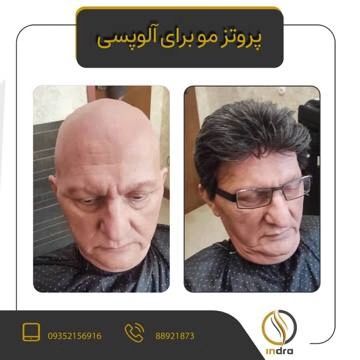 مرکز تخصصی اسکالپ سر ایندرا | بهترین کلینیک اسکالپ سر در تهران