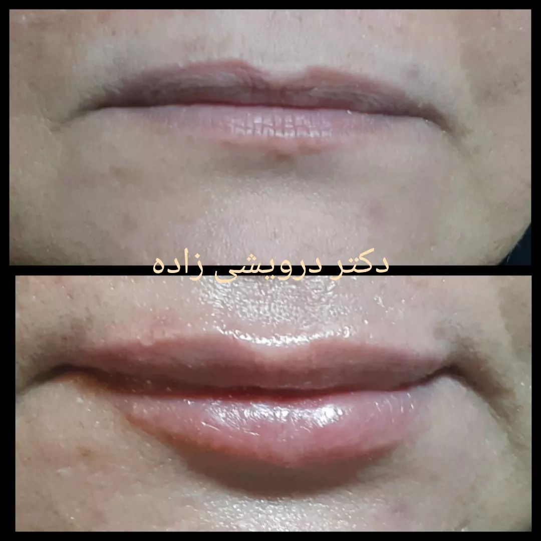 دکتر نادیا درویشی زاده متخصص میکرودرم| بهترین پزشک میکرودرم در تهران