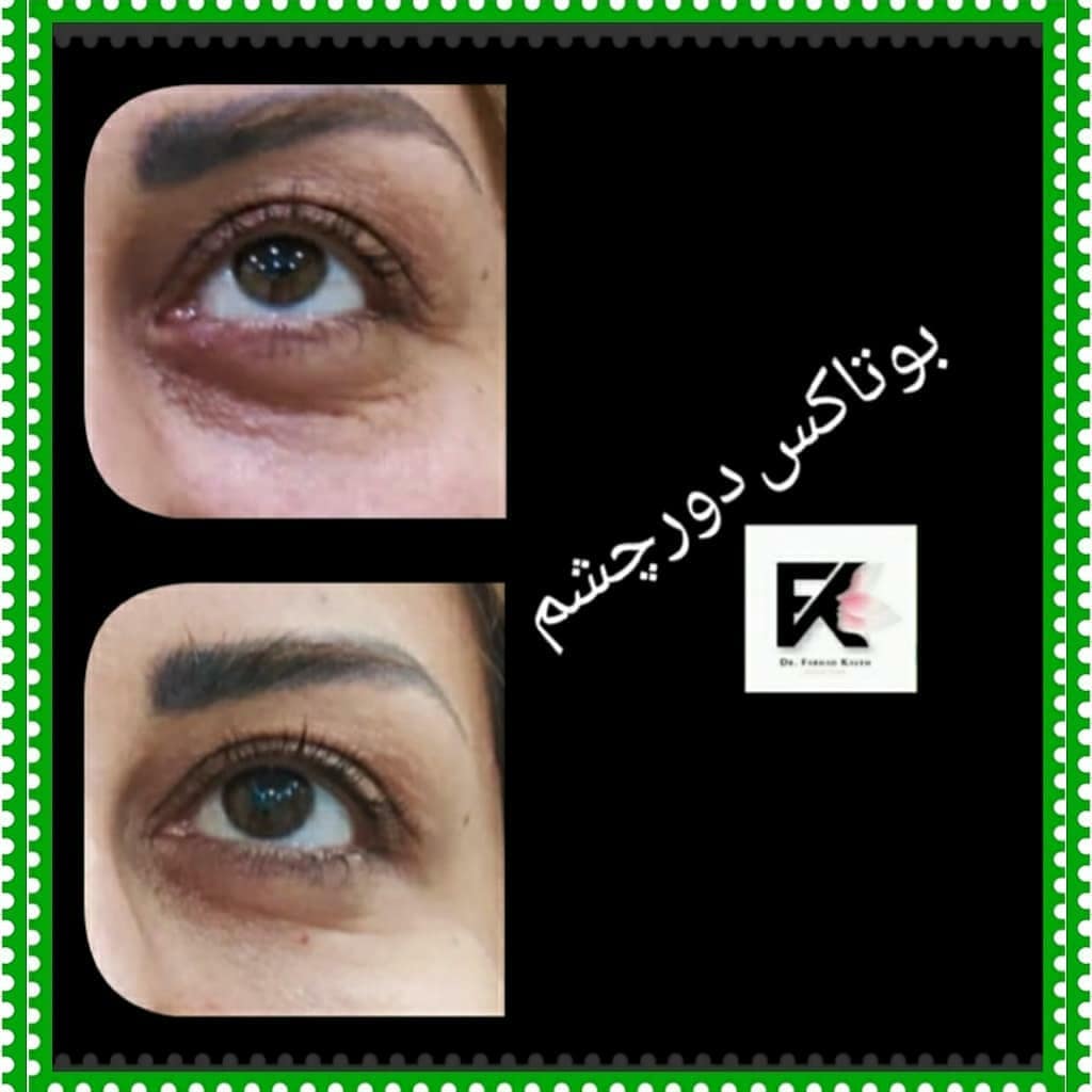 دکتر فرهاد کاوه بهترین پزشک کربوکسی تراپی در کرج| بهترین متخصص کربوکسی تراپی در کرج