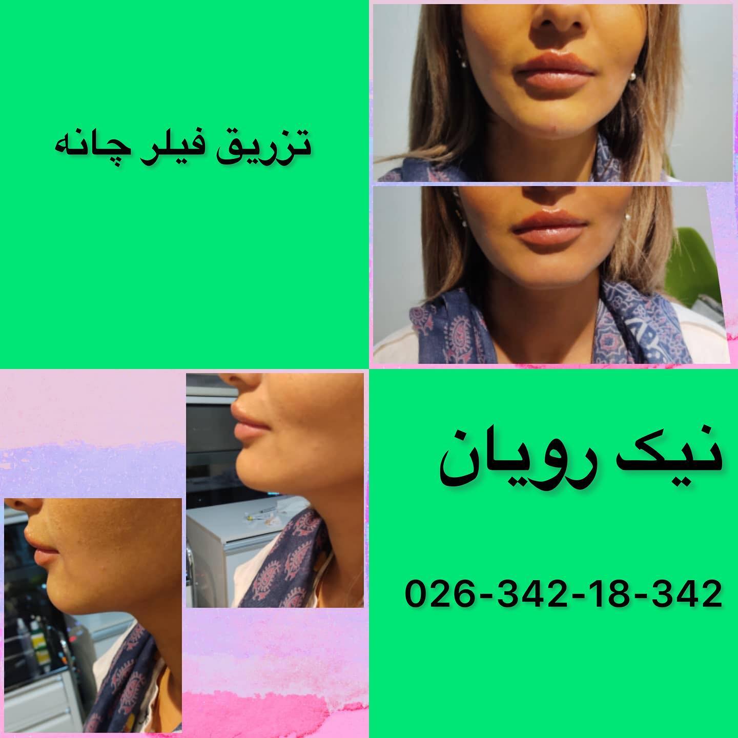 مرکز زیبایی نیک رویال در کرج | بهترین مرکز کربوکسی تراپی در کرج