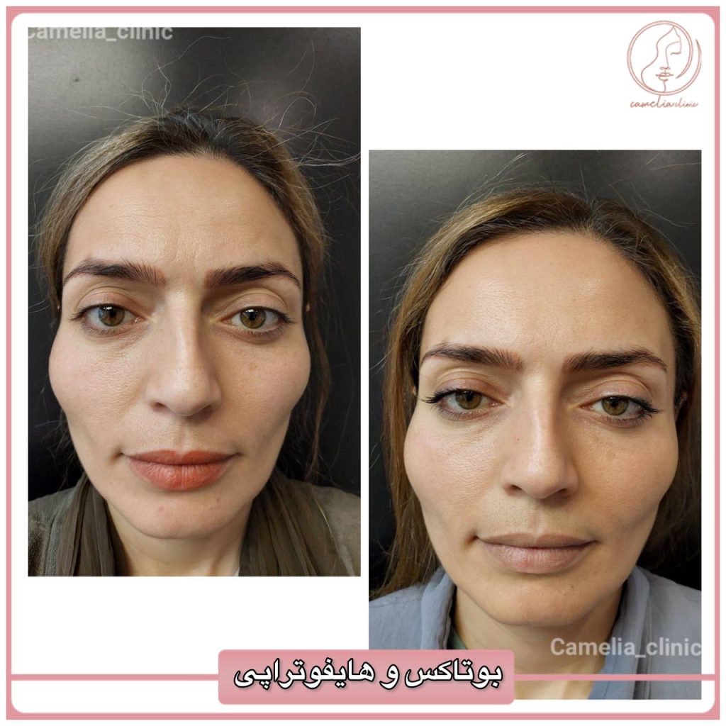 مرکز زیبایی کاملیا بهترین کلینیک پیلینگ در کرج |بهترین کلینیک پیلینگ در کرج