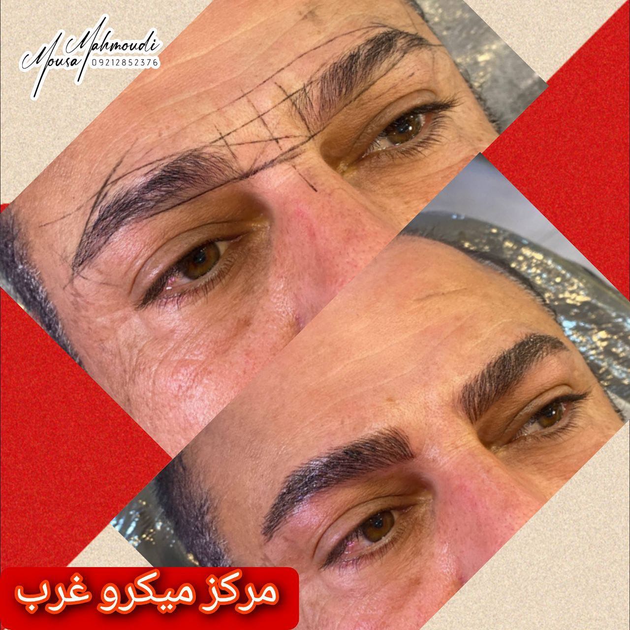 مرکز تخصصی میکرو اسکالپ غرب| بهترین کلینیک اسکالپ سر در تهران