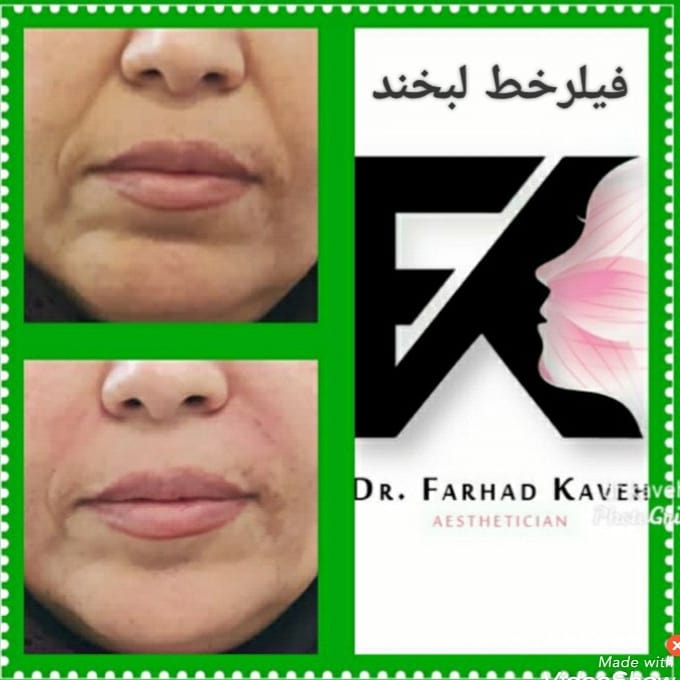دکتر فرهاد کاوه بهترین متخصص کربوکسی تراپی در کرج| بهترین پزشک کربوکسی تراپی در کرج