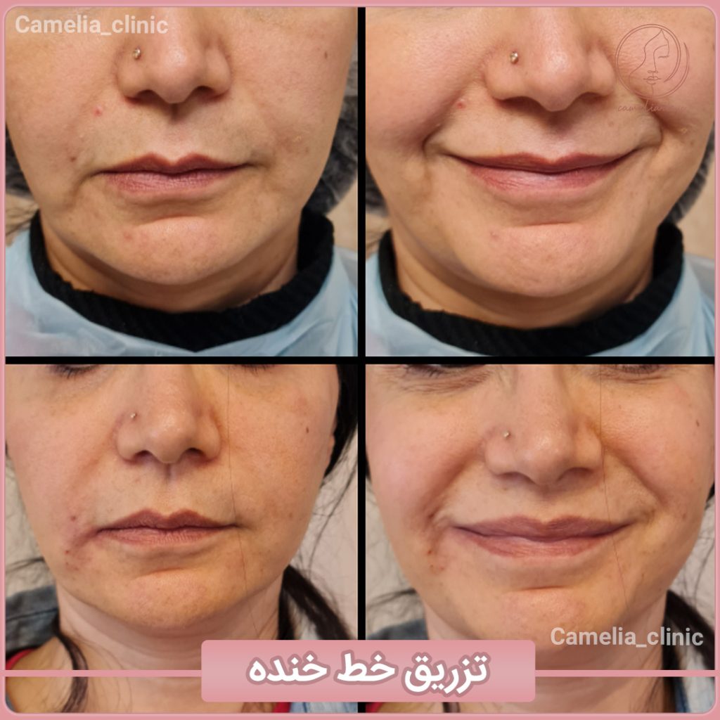 مرکز تخصصی کاملیا بهترین مطب پیلینگ در کرج |بهترین کلینیک پیلینگ در کرج