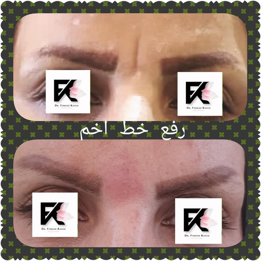 دکتر فرهاد کاوه بهترین متخصص کربوکسی تراپی در کرج| بهترین پزشک کربوکسی تراپی در کرج