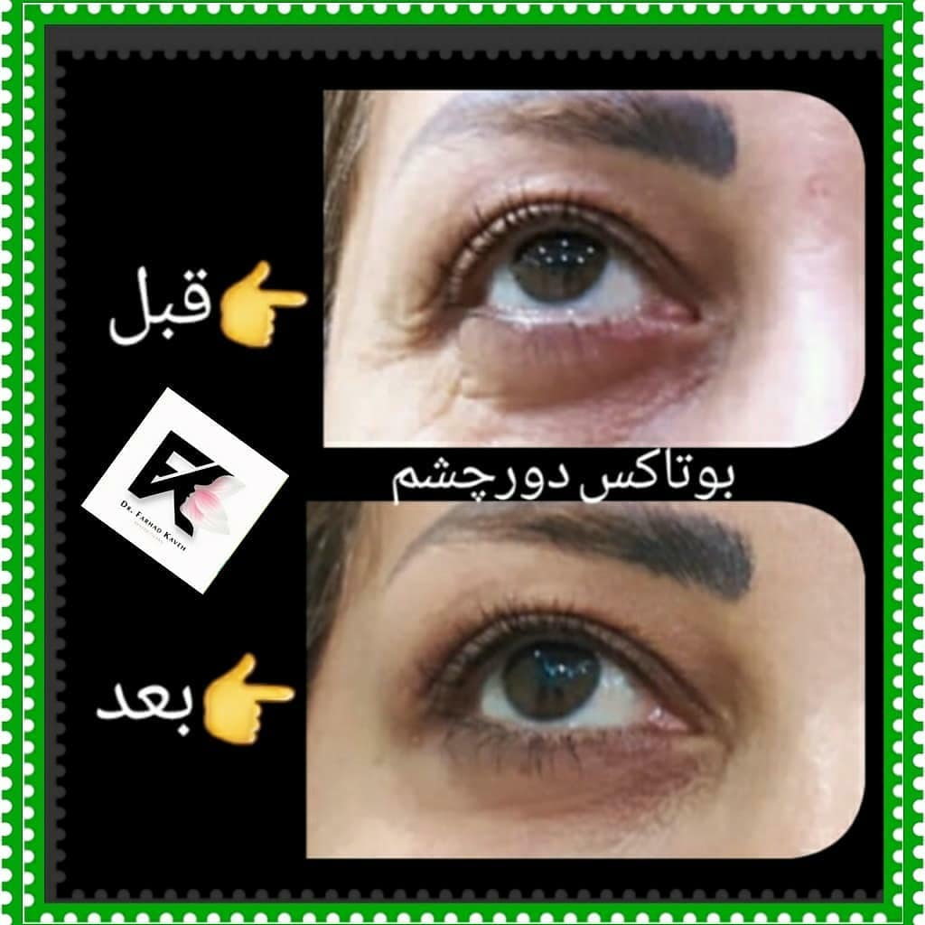 دکتر فرهاد کاوه بهترین متخصص کربوکسی تراپی در کرج| بهترین دکتر کربوکسی تراپی در کرج