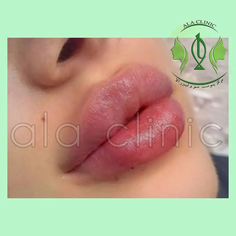 کلینیک تخصصی پوست، مو و لیزر آلا در کرج | معروف ترین مرکز کربوکسی تراپی در کرج