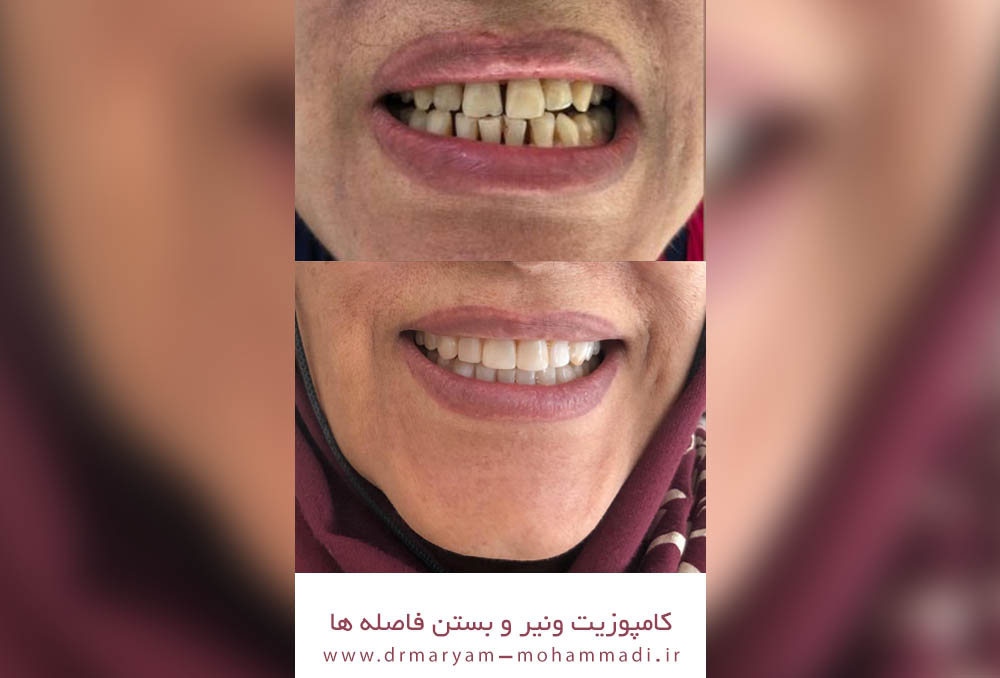 دکتر مریم محمدی متخصص ونیر کامپوزیت کرج | بهترین متخصص کامپوزیت کرج