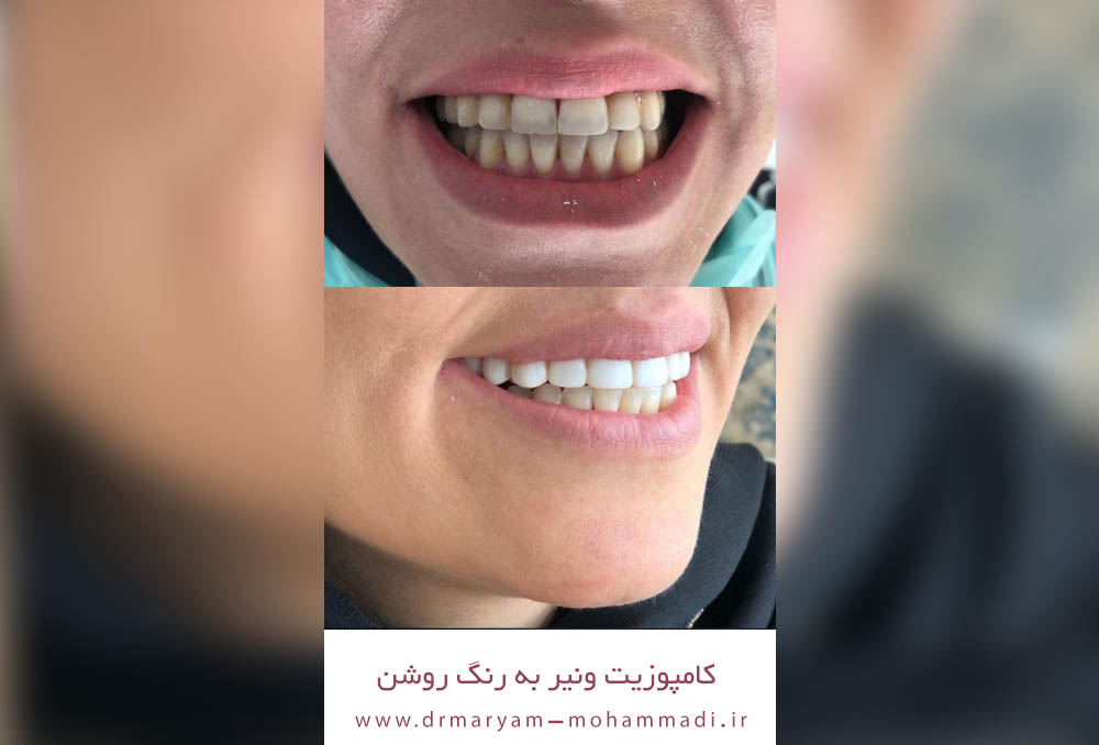 دکتر مریم محمدی بهترین متخصص ونیر کامپوزیت کرج | بهترین دکتر کامپوزیت کرج