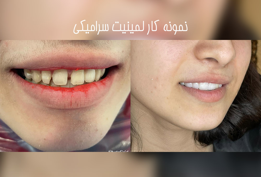 دکتر مریم محمدی متخصص ونیر کامپوزیت کرج | بهترین متخصص کامپوزیت کرج