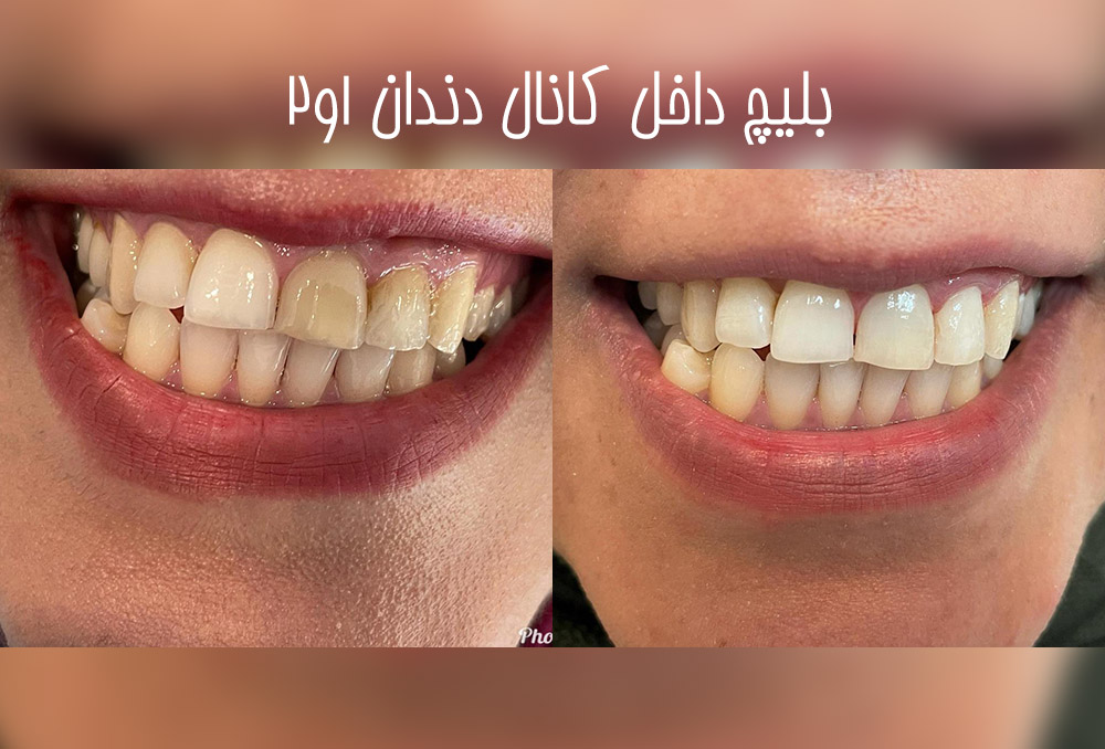 دکتر مریم محمدی بهترین پزشک ونیر کامپوزیت کرج | معروف ترین دکتر کامپوزیت کرج