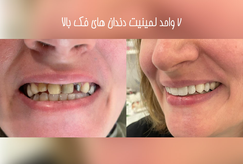 دکتر مریم محمدی بهترین متخصص ونیر کامپوزیت کرج | بهترین دکتر کامپوزیت کرج