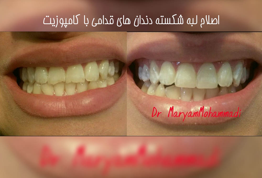 دکتر مریم محمدی بهترین متخصص ونیر کامپوزیت کرج | بهترین دکتر کامپوزیت کرج