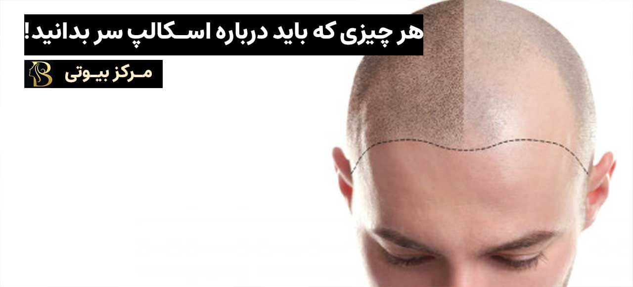 هر چیزی که باید درباره میکروپیگمنتیشن پوست سر یا اسکالپ سر بدانید | مرکز بیوتی