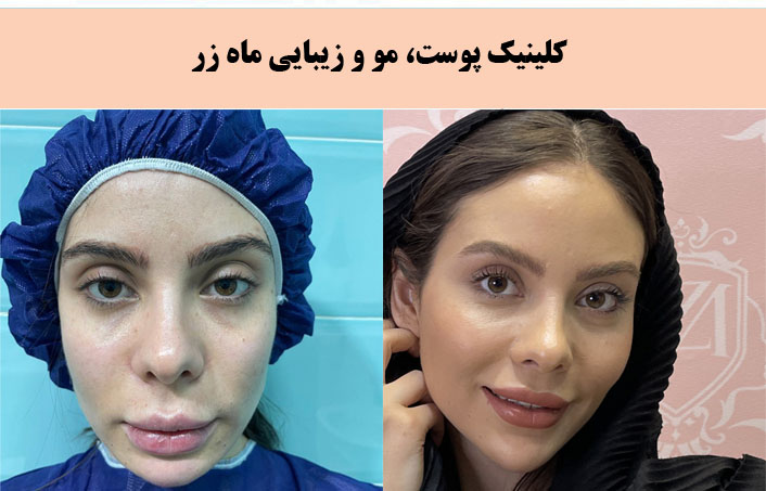 کلینیک زیبایی ماه زر بهترین کلینیک پیلینگ در تهران |بهترین مرکز پیلینگ در تهران