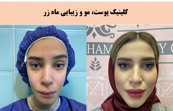 کلینیک زیبایی ماه زر بهترین کلینیک پیلینگ در تهران |بهترین مرکز پیلینگ در تهران