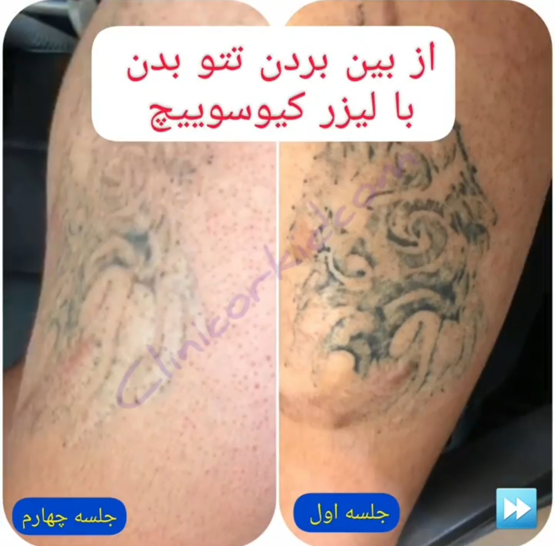 کلینیک تخصصی ارکید مرکز میکرودرم| بهترین مطب میکرودرم در تهران