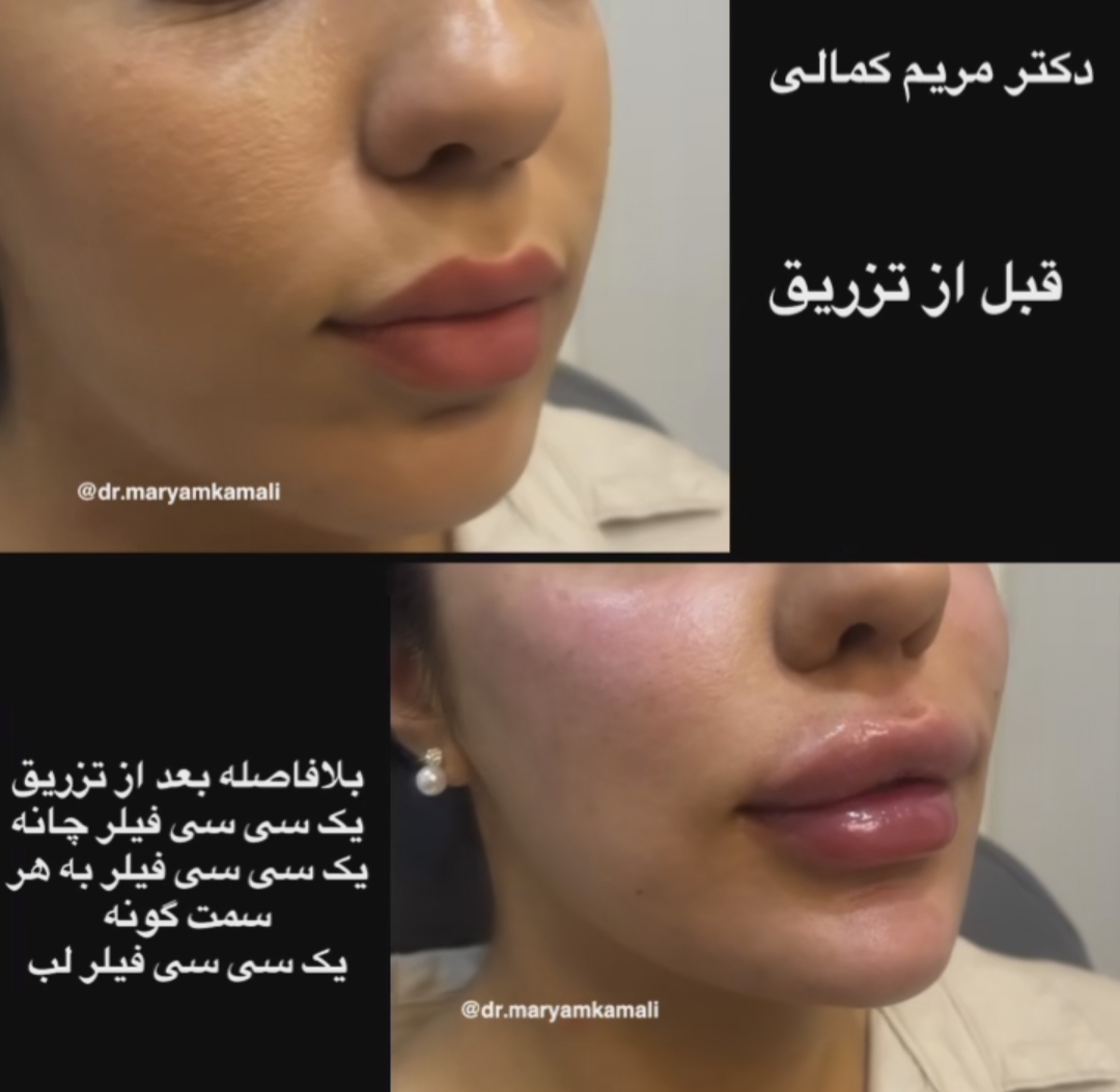 دکتر مریم کمالی بهترین متخصص کربوکسی تراپی در کرج| بهترین دکتر کربوکسی تراپی در کرج