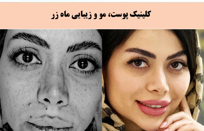 مطب زیبایی ماه زر برجسته ترین کلینیک پیلینگ در تهران |بهترین کلینیک پیلینگ در تهران
