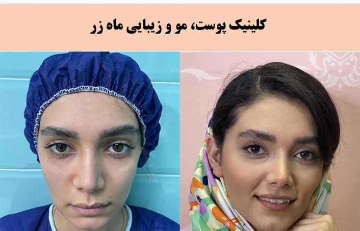 کلینیک زیبایی ماه زر بهترین کلینیک پیلینگ در تهران |بهترین مرکز پیلینگ در تهران