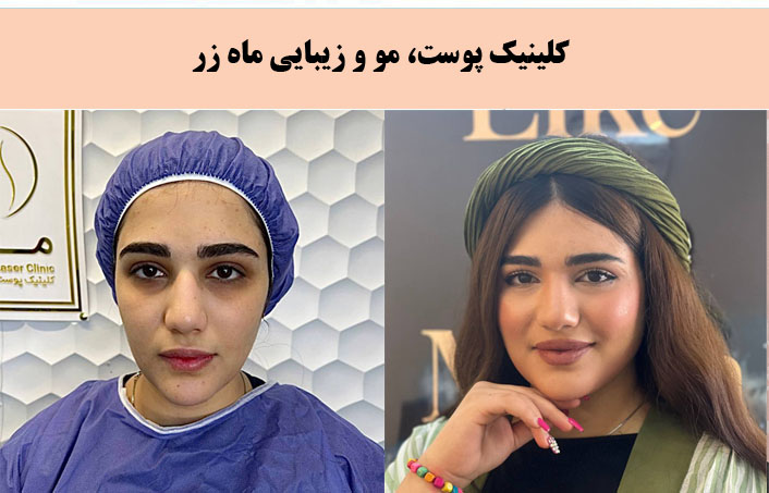 کلینیک زیبایی ماه زر معروف ترین مطب پیلینگ در تهران |بهترین مرکز پیلینگ در تهران