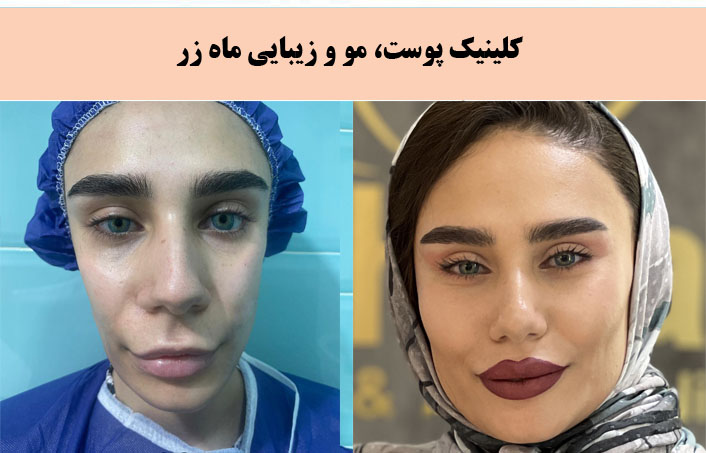 کلینیک زیبایی ماه زر بهترین کلینیک پیلینگ در تهران |بهترین مرکز پیلینگ در تهران