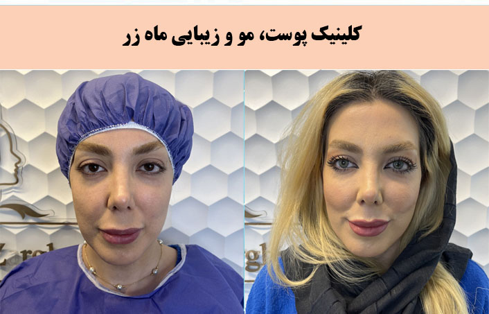 مطب زیبایی ماه زر برجسته ترین کلینیک پیلینگ در تهران |بهترین کلینیک پیلینگ در تهران