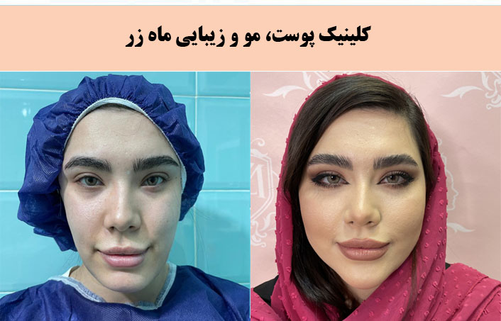 مطب زیبایی ماه زر برجسته ترین کلینیک پیلینگ در تهران |بهترین کلینیک پیلینگ در تهران