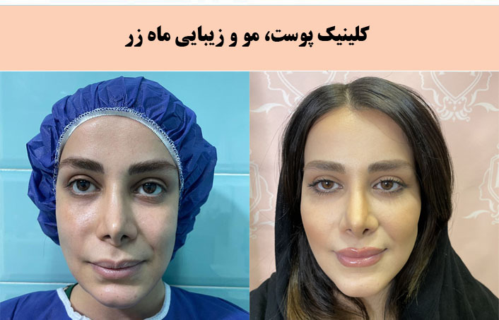 کلینیک زیبایی ماه زر معروف ترین مطب پیلینگ در تهران |بهترین مرکز پیلینگ در تهران