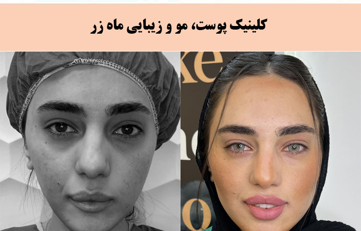 مطب زیبایی ماه زر برجسته ترین کلینیک پیلینگ در تهران |بهترین کلینیک پیلینگ در تهران