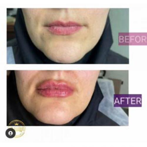 نمونه قبل وبعد تزریق ژل لب توسط کلینیک آپیلنس در کرج