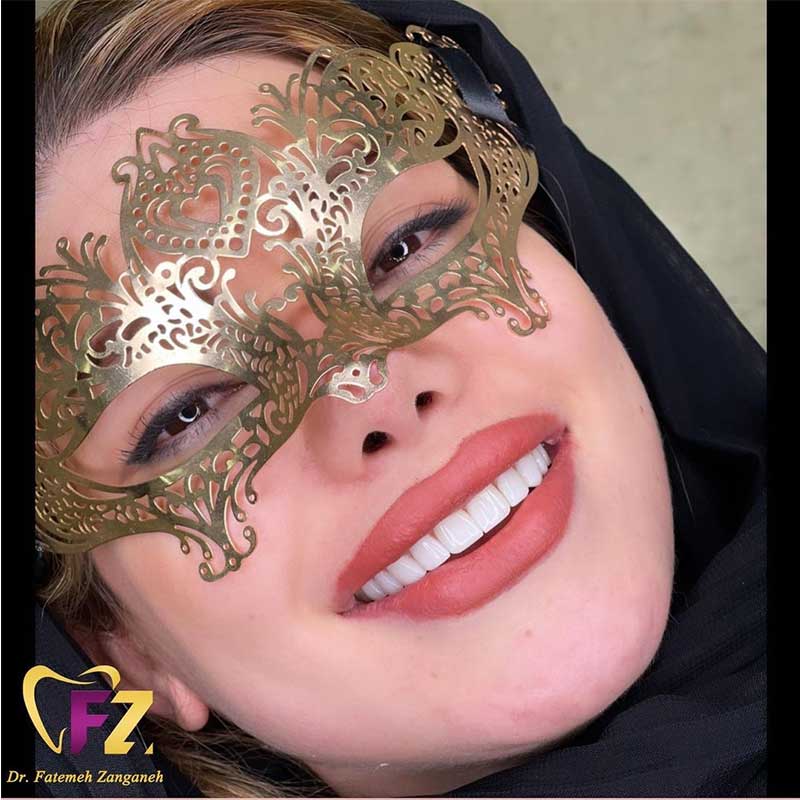 بهترین متخصص ونیر کامپوزیت در تهران | مرکز بیوتی
