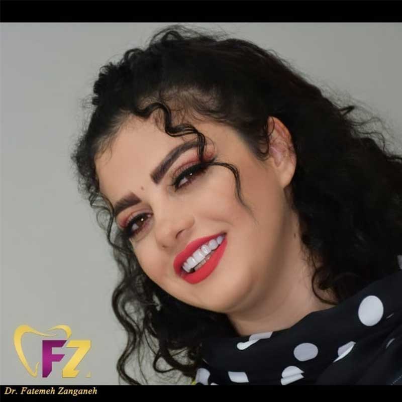 بهترین دکتر ونیر کامپوزیت در تهران | مرکز بیوتی
