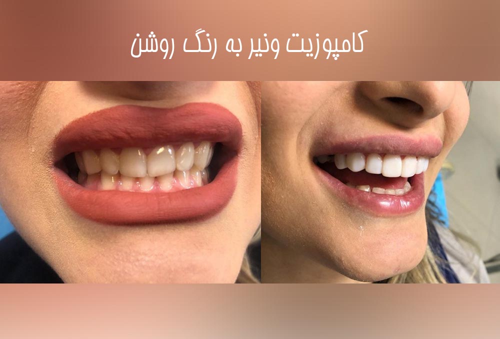 دکتر مریم محمدی متخصص ونیر کامپوزیت کرج | بهترین متخصص کامپوزیت کرج