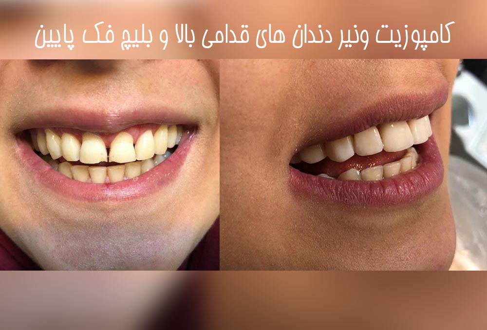 دکتر مریم محمدی بهترین پزشک ونیر کامپوزیت کرج | معروف ترین دکتر کامپوزیت کرج