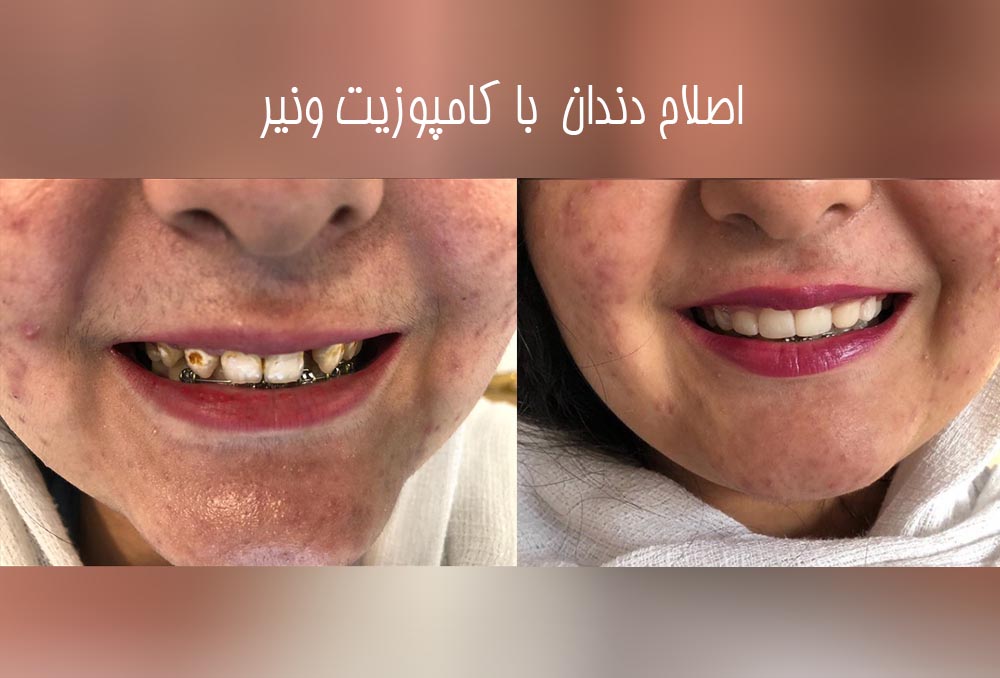 دکتر مریم محمدی بهترین متخصص ونیر کامپوزیت کرج | بهترین دکتر کامپوزیت کرج