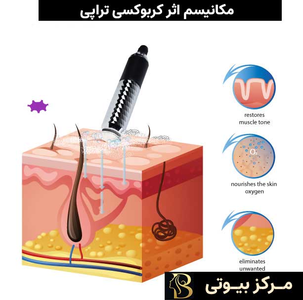 مکانیسم اثر کربوکسی تراپی |مرکز بیوتی