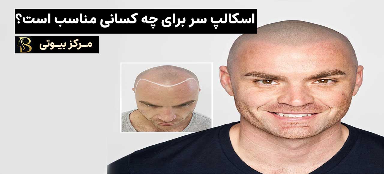اسکالپ سر برای چه کسانی مناسب است؟ | مرکز بیوتی