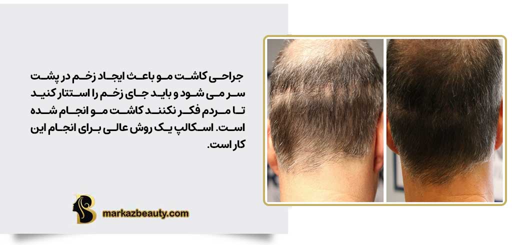 استتار اسکار پوستی با میکروپیگمنتیشن پوست سر | مرکز بیوتی