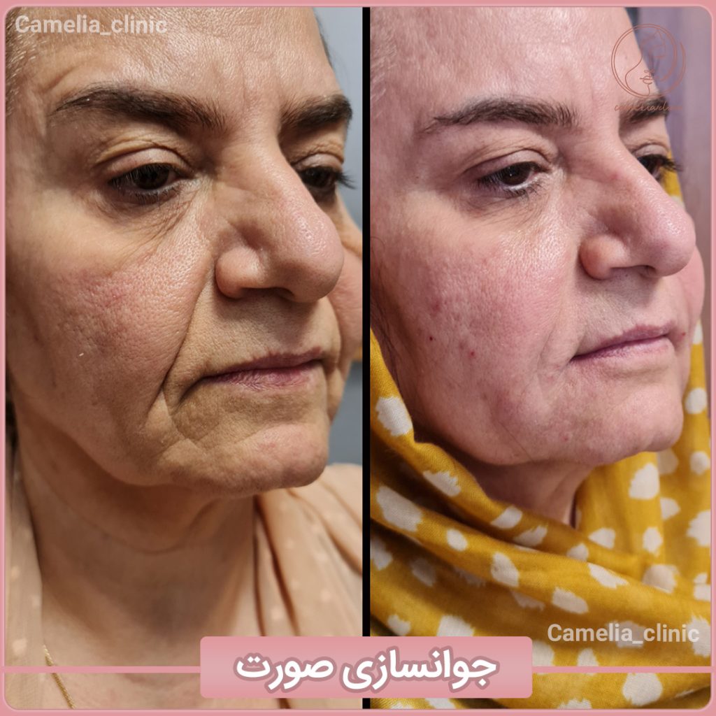 مرکز کاملیا بهترین کلینیک پیلینگ در کرج |بهترین مرکز پیلینگ در کرج