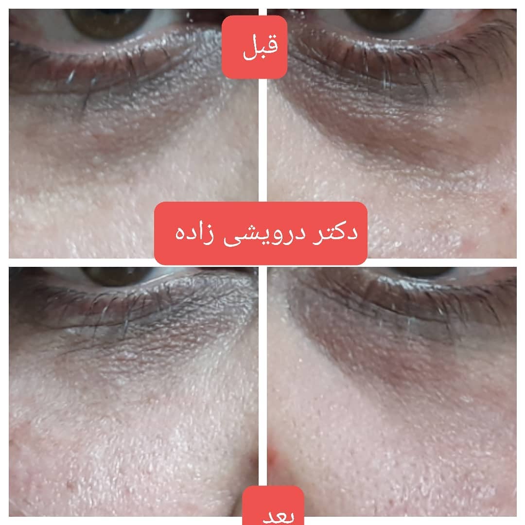 دکتر نادیا درویشی زاده متخصص میکرودرم| بهترین متخصص میکرودرم در تهران