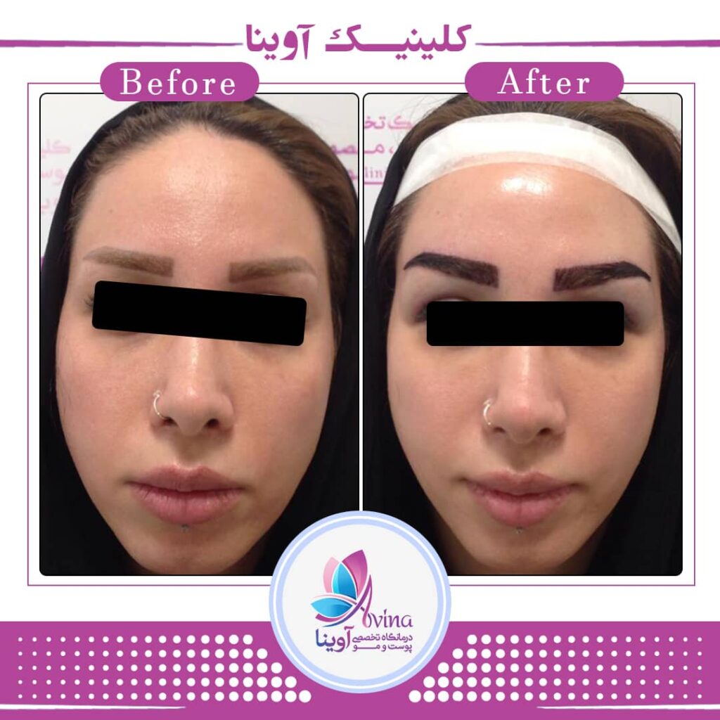 مرکز زیبایی آوینا | بهترین کلینیک کربوکسی تراپی در تهران