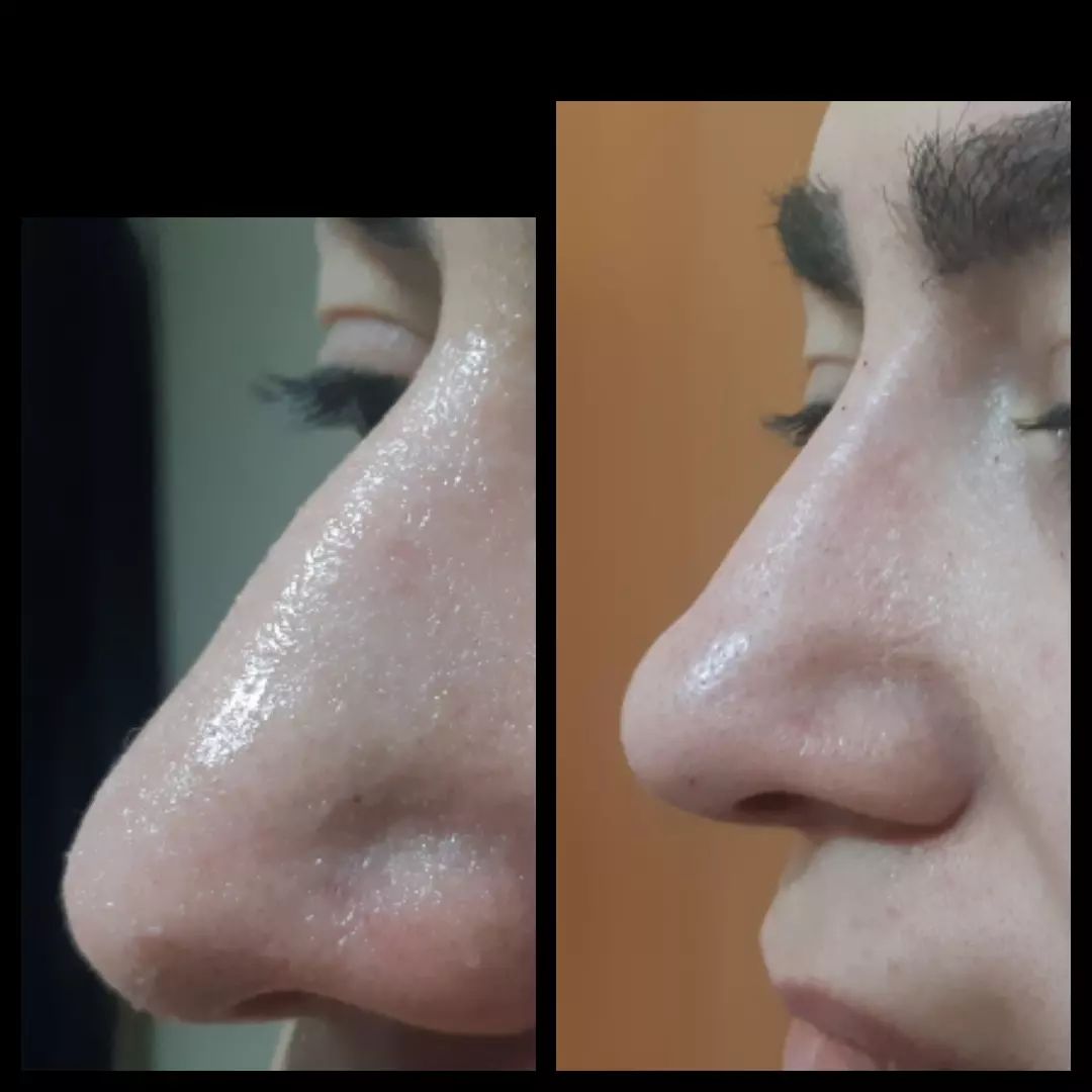 دکتر نادیا درویشی زاده متخصص میکرودرم| بهترین پزشک میکرودرم در تهران