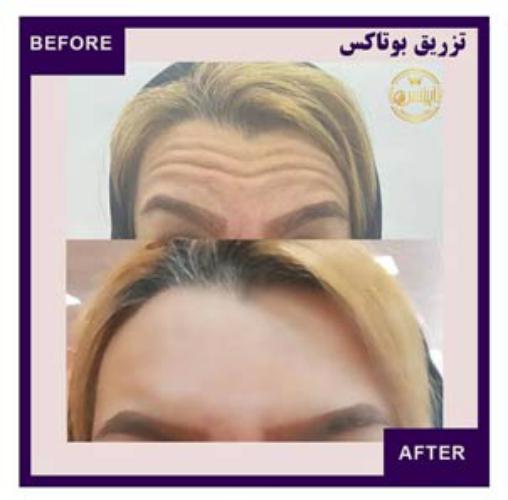 نمونه قبل و بعد از تزریق بوتاکس در کلینیک آپیلنس در کرج