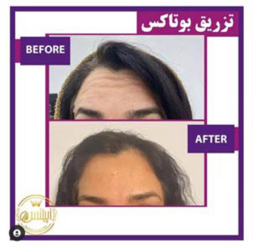 نمونه قبل و بعد تزریق بوتاکس انجام شده توسط کلینیک آپیلنس در کرج
