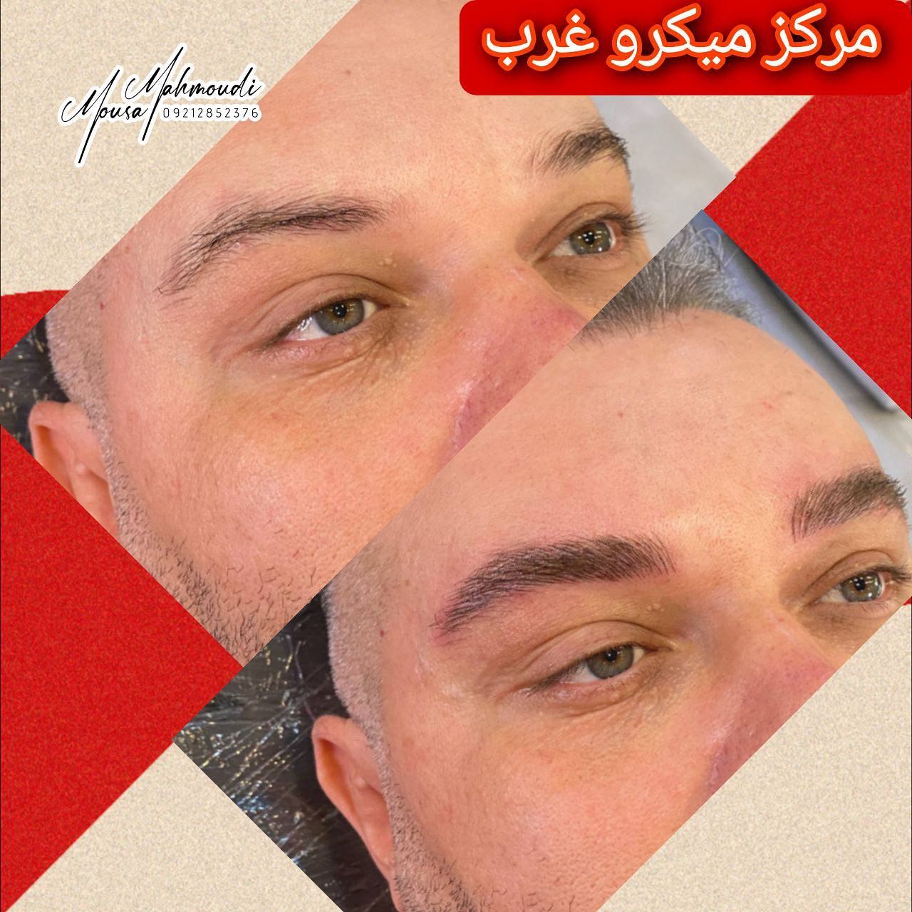 کلینیک تخصصی میکرو اسکالپ غرب| بهترین کلینیک اسکالپ سر در تهران