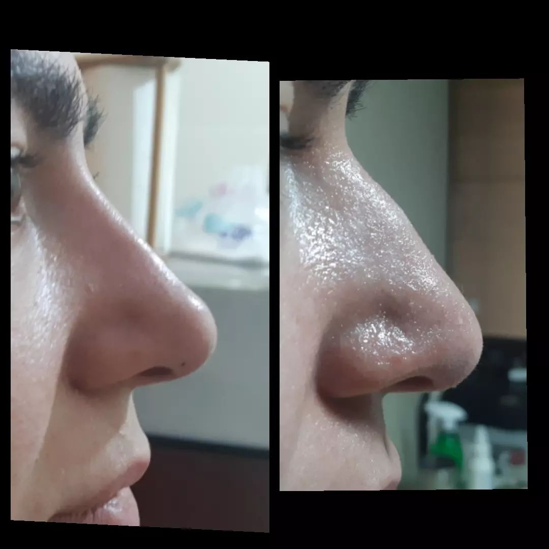 دکتر نادیا درویشی زاده پزشک میکرودرم| بهترین پزشک میکرودرم در تهران